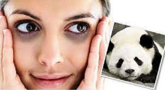 penyebab mata panda