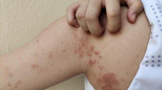 Ilustrasi pemeriksaan kulit untuk deteksi dini kusta