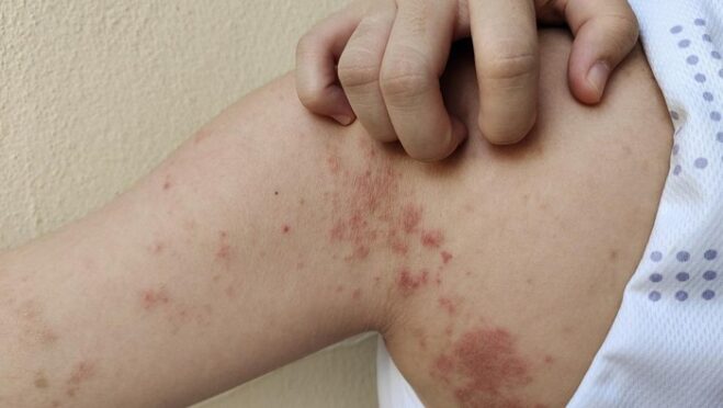 Ilustrasi pemeriksaan kulit untuk deteksi dini kusta