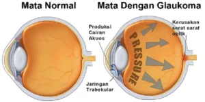 Waspada Glaukoma: Penyakit Mata Tanpa Gejala yang Bisa Menghilangkan Penglihatan Anda!