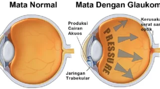 Waspada Glaukoma: Penyakit Mata Tanpa Gejala yang Bisa Menghilangkan Penglihatan Anda!