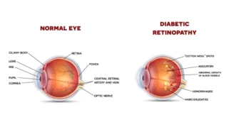 Apa Itu Retinopati Diabetik?