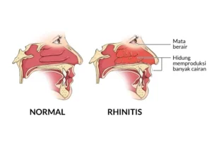 Cuaca Tak Menentu, Waspadai Rhinitis Alergi Berkepanjangan dan Cara Penanganannya