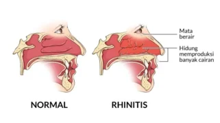 Cuaca Tak Menentu, Waspadai Rhinitis Alergi Berkepanjangan dan Cara Penanganannya