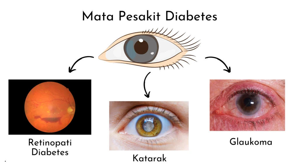 Faktor Risiko dan Dampak Diabetes pada Mata