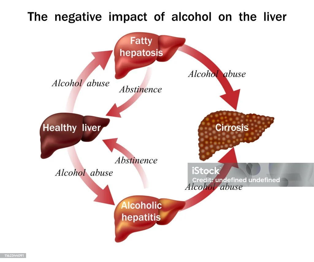 Gejala Kerusakan Hati pada Penderita Alkohol