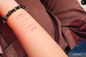 Insanul Fahmi Unggah Foto Tangan Berdarah, Suami Mawa Ikut Pamer Luka di Media Sosial