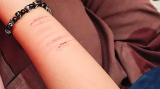 Insanul Fahmi Unggah Foto Tangan Berdarah, Suami Mawa Ikut Pamer Luka di Media Sosial