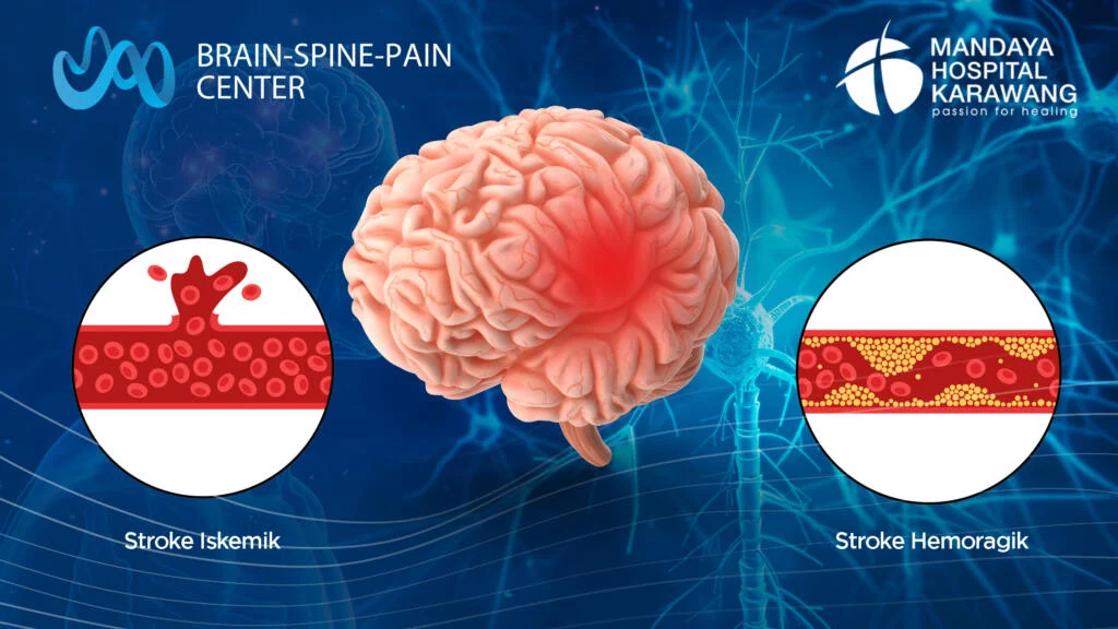 Mengapa Risiko Diabetes Meningkat Setelah Stroke?