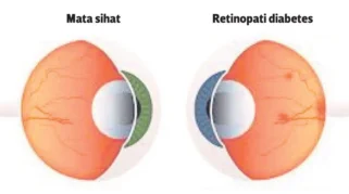 Penglihatan Kabur Akibat Diabetes: Apa yang Terjadi pada Mata?