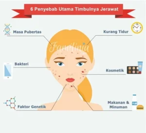 Penyebab Jerawat pada Remaja