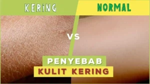 Penyebab Kulit Kering