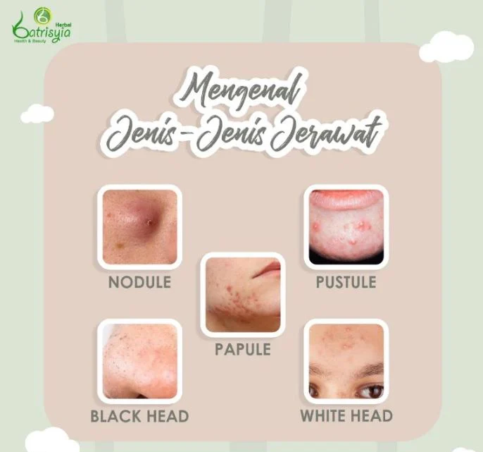Tabel Referensi Perawatan Berdasarkan Jenis Jerawat