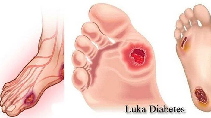FAQ – Pertanyaan Umum tentang Luka Lambat Sembuh pada Diabetes