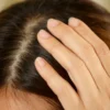Bukan Ketombe Biasa: Cara Mengatasi Kulit Kepala Kering yang Sering Disalahartikan