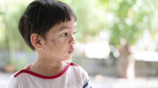 Apakah Anak Kena Cacar Air Boleh Mandi?