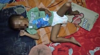 Perawatan Balita Penderita Stunting di Kasemen: Kasus Juned Jadi Sorotan